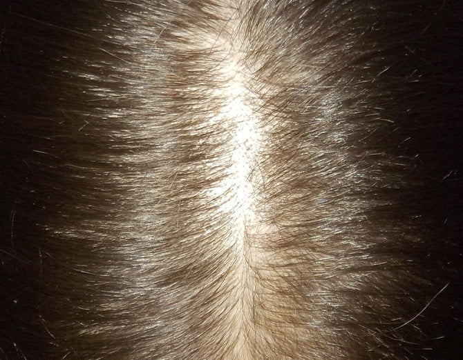 Dettaglio del cuoio capelluto con diradamento visibile: situazione prima del trattamento Bioscalin® MENOPAUSA