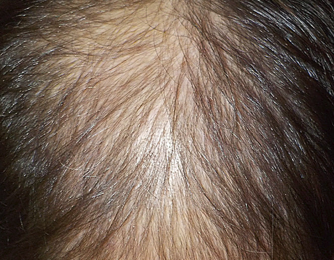 Risultato dopo il trattamento Bioscalin® PRO•DENSITY: chioma visibilmente più folta e forte