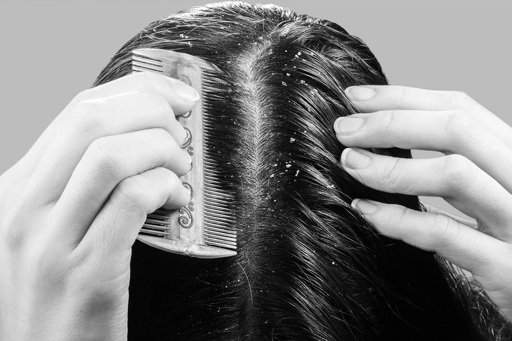 FORFORA, UN PROBLEMA NON SOLO DEI CAPELLI GRASSI