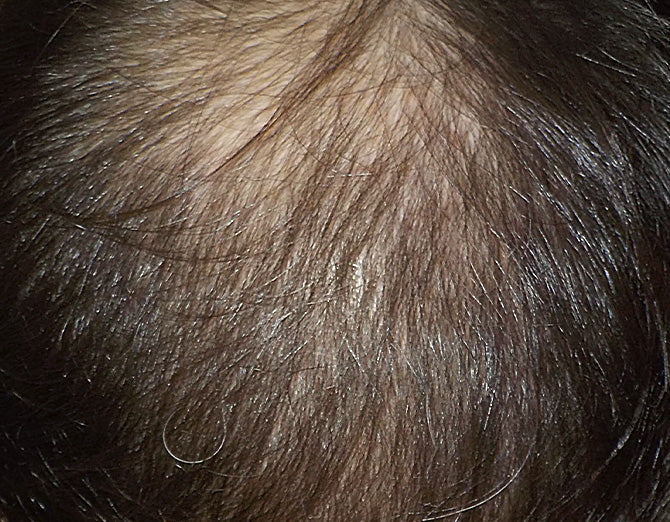 Dettaglio del cuoio capelluto con diradamento visibile: situazione prima del trattamento Bioscalin® PRO•DENSITY.